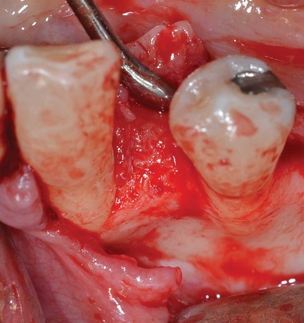 Tarquini_Periodontal intrabony defect